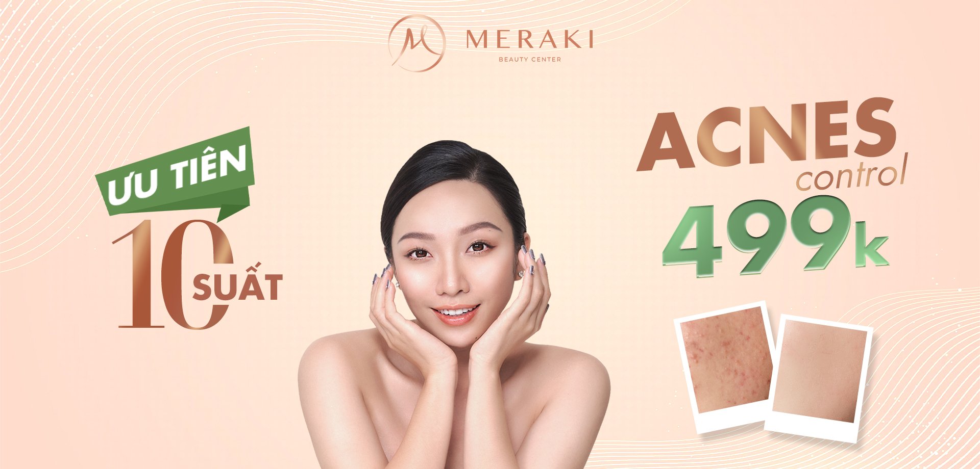 acnes control webiste