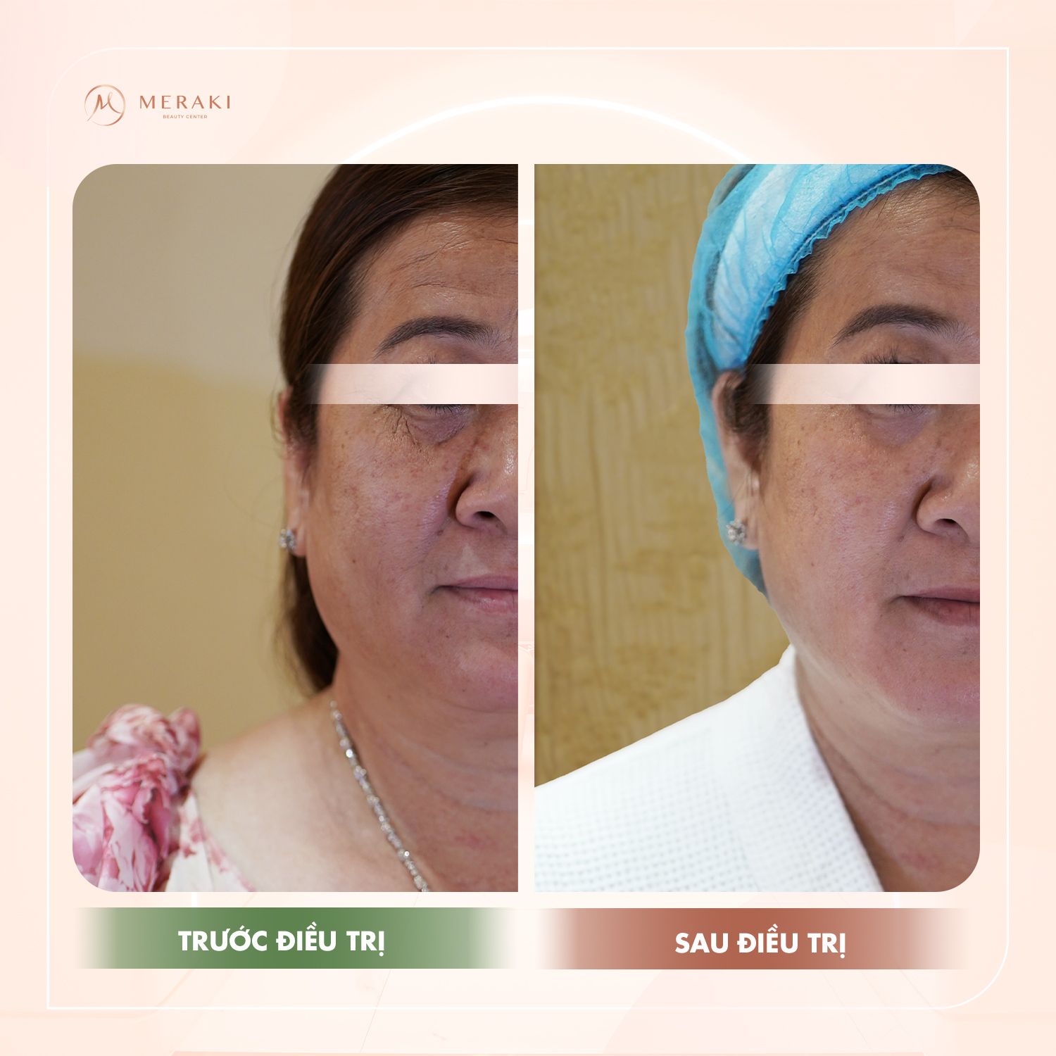 công nghệ Thermage và Ultherapy