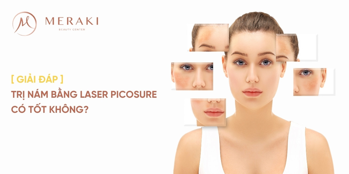 trị nám bằng Laser Picosure có tốt không?