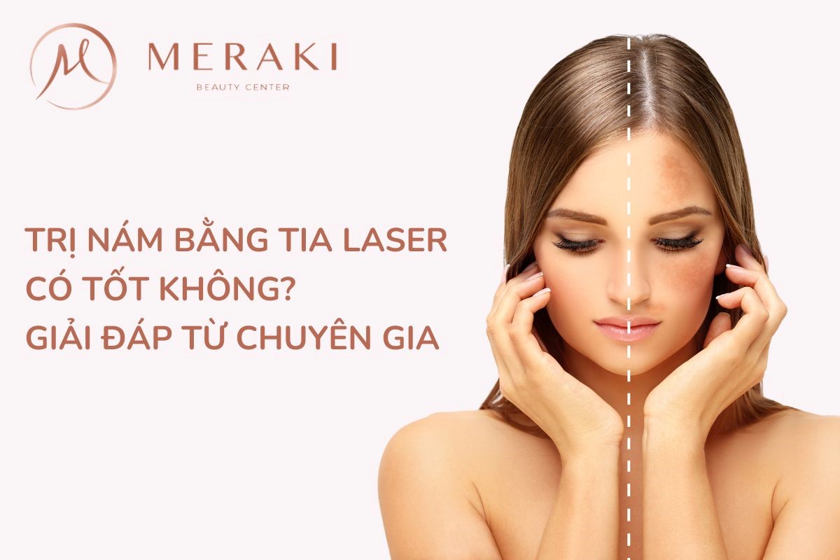 Trị nám bằng tia Laser có tốt không ?